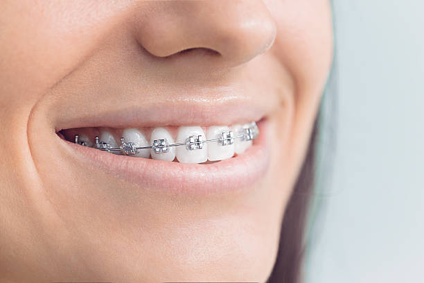 Best Traditional Braces  in Horseheads North, NY